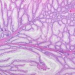 “Mixed histology polyp.” Image by Caoimhin74, via Wikimedia Commons, licensed under CC BY-SA 3.0.